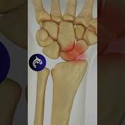 Scaphoid Fracture Surgery 4K 3D Medical Animation