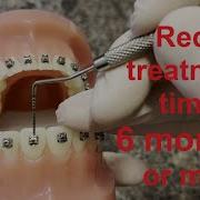How To Place Position Braces