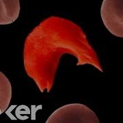 What Is Sickle Cell Anemia And How Do You Get It
