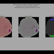 Malaria Detection Using Deep Learning