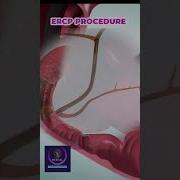 ERCP Procedure For Bile Duct Obstruction Removal