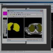 Lung Pulmonary Nodule Segmentation 3D Matlab Projects