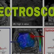 Mri Spectroscopy How To Read Mri Spectroscopy Spectroscopy Filming Planing Pathology
