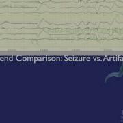 Persyst Rhythmicity Spectrogram Case Study