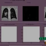 Final Year Projects A Computer Aided Diagnosis System For Lung Cancer Detection Using Machine