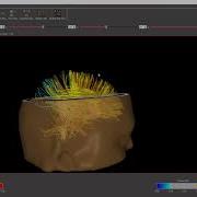 NeuroGuide NeuroNavigator With DTI All Fiber Bundles