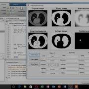 Detecting A Lung Cancer Using MATLAB Image Processing