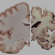 Alzheimer S And The Brain