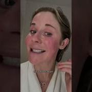 Do You Have A Sunburn Nope Just Rosacea What Causes Your Rosacea To Flare Rosacea
