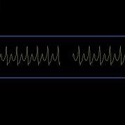 Supraventricular Tachycardia SVT Rhythm Waveform Simulated Patient Waveform