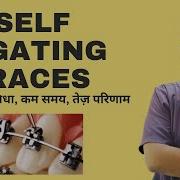 Dr Rudra Mohan सरल त ज ब हतर प रक र क ब र स ज Self Ligating Braces Brackets Dental Braces