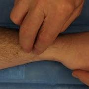 Wartenberg S Syndrome And Wartenberg S Sign
