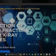 Bone Fracture Detection Using CNN In Deep Learning