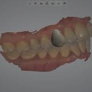 3Shape 덴탈 시스템 덴탈 시스템에서 Patient Specific Motion 사용하기