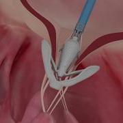 PASCAL Repair System Features Implantation Of The System In The Mitral Valve Animation