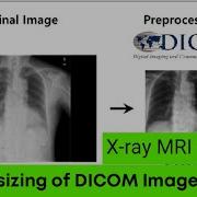 How To Resize The DICOM Images Preprocessing Processing X Ray MRI CT Scan ITFO