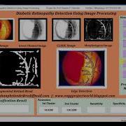 Matlab Code For Diabetic Retinopathy Detection Using Image Processing Full Source Code