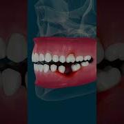 What REALLY Happens When You Lose A Tooth Dentalimplants Balham Eastfinchley Teeth Health