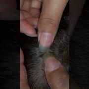 Part 36 Lice Removal Treatment Satisfying Lice Popping
