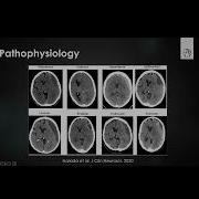 EANS WEBINARS CHRONIC SUBDURAL HEMATOMAS CSDH