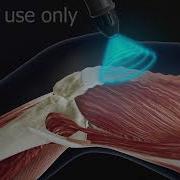 Только для использования в качестве образца медицинской анимации 3D ударно волновой терапии