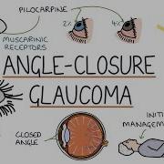 Understanding Acute Angle Closure Glaucoma