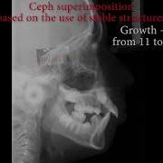 Ceph Superimposition Based On The Use Of Stable Structures On A Computer Before AI