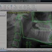 AudaxCeph VTO Orthodontic And Surgical Treatment Plan