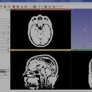 3D Slicer MatlabBridge Editing And Debugging Your Module