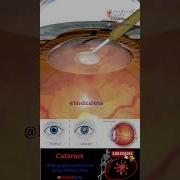 Cataract Lens Implant Medical Arts Shorts 3d Animation Surgery
