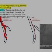 Coronary Dissections Cases Types Treatment Tips