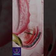 Stone Removal From Bile Ducts ERCP Procedure