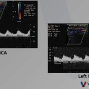 Common Carotid Artery Occlusion