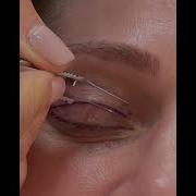 Upper Blepharoplasty Markings