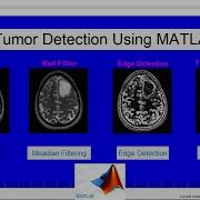 Brain Tumor Detection Using MATLAB GUI With Source Code Image Processing 2022