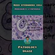 Reed Sternberg Cell In Hodgkin S Lymphoma Pathology Shorts