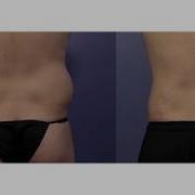 Liposuction At Stoker Plastic Surgery Los Angeles