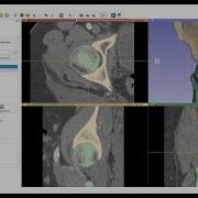 Femur Segmentation Using Masked Region Growing In 3D Slicer