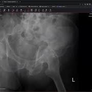 Pelvic Fracture Fix Don T Miss The Subtle Signs Of Impaction On X Ray
