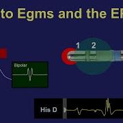 Intro To Intra Cardiac Electrograms The EP Lab