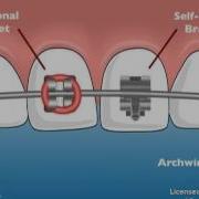 Vincent Team Orthodontics Self Ligating Braces