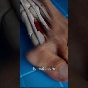 Bunion Correction Explained