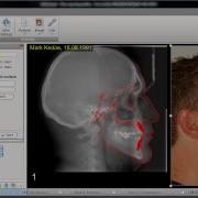 AudaxCeph Superimposition Of An Image