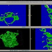 3D Vertebrae Model Creation Process Using Itk SNAP