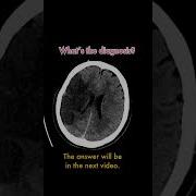 Spot Diagnosis On CT Brain Radiology Medicine Medicalstudent Dontmissthis Spotdiagnosis