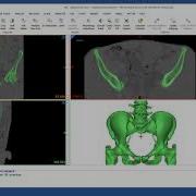 How To Use Region Growing In Mimics Mimics Innovation Suite Materialise Medical