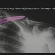Bone Fracture Detection Cogito