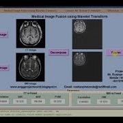Medical Image Fusion Using Wavelet Transform Matlab Project Source Code Image Fusion Using DWT