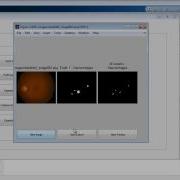 Diabetic Retinopathy Detection Classification Matlab Code Projects