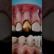 Why Dentists Still Use Gold Teeth